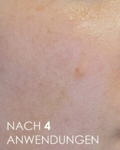 Pigmentfleck nach Behandlung mit Dalton Marine
