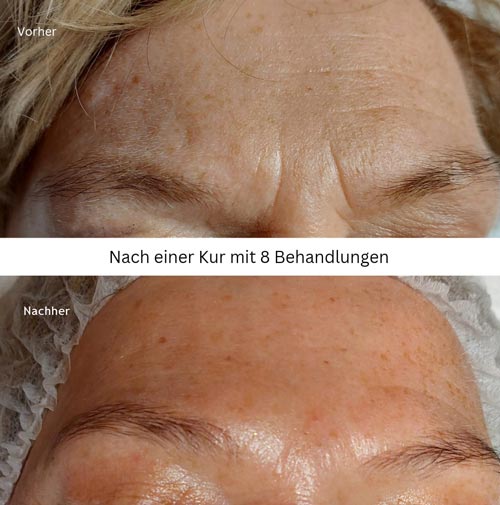 Tolle Verbesserung der Haut